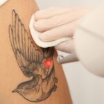 Tattoo Removal