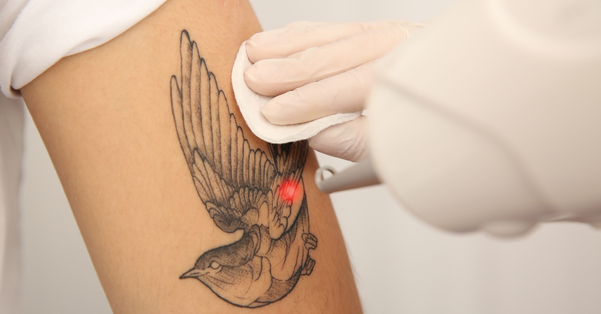 Tattoo Removal